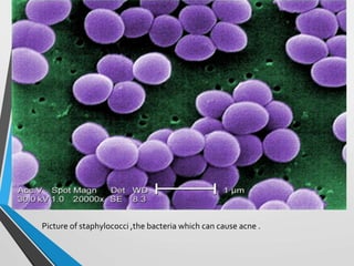 Picture of staphylococci ,the bacteria which can cause acne .
 
