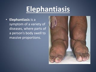 Elephantiasis
• Elephantiasis is a
symptom of a variety of
diseases, where parts of
a person's body swell to
massive propo...