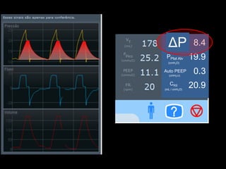 (cmH2O)
PDriving
(cmH2O)
PPlat Alv
(cmH2O)
Auto PEEP
CRS
(mL / cmH2O)
8.4
19.9
0.3
20.9
ΔP
 