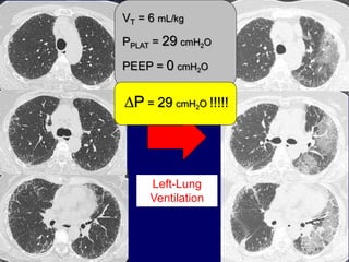 LIM 09 - HCFMUSP
Anesthesia
Left-Lung
Ventilation
VT = 6 mL/kg
PPLAT = 29 cmH2O
PEEP = 0 cmH2O
DP = 29 cmH2O !!!!!
 