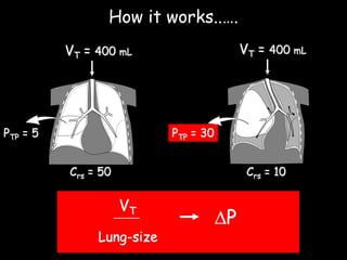 35 cmH O2
P =p l
15
spulmonary:
20 cmH O2
P =p l
-5
35 cmH O2
Transpulmonary:
40 cmH O2
VT
DP
VT = 400 mL VT = 400 mL
PTP = 5 PTP = 30
Crs = 10Crs = 50
How it works..….
Lung-size
 