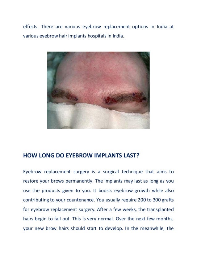 effects. There are various eyebrow replacement options in India at
various eyebrow hair implants hospitals in India.
HOW LONG DO EYEBROW IMPLANTS LAST?
Eyebrow replacement surgery is a surgical technique that aims to
restore your brows permanently. The implants may last as long as you
use the products given to you. It boosts eyebrow growth while also
contributing to your countenance. You usually require 200 to 300 grafts
for eyebrow replacement surgery. After a few weeks, the transplanted
hairs begin to fall out. This is very normal. Over the next few months,
your new brow hairs should start to develop. In the meanwhile, the
 