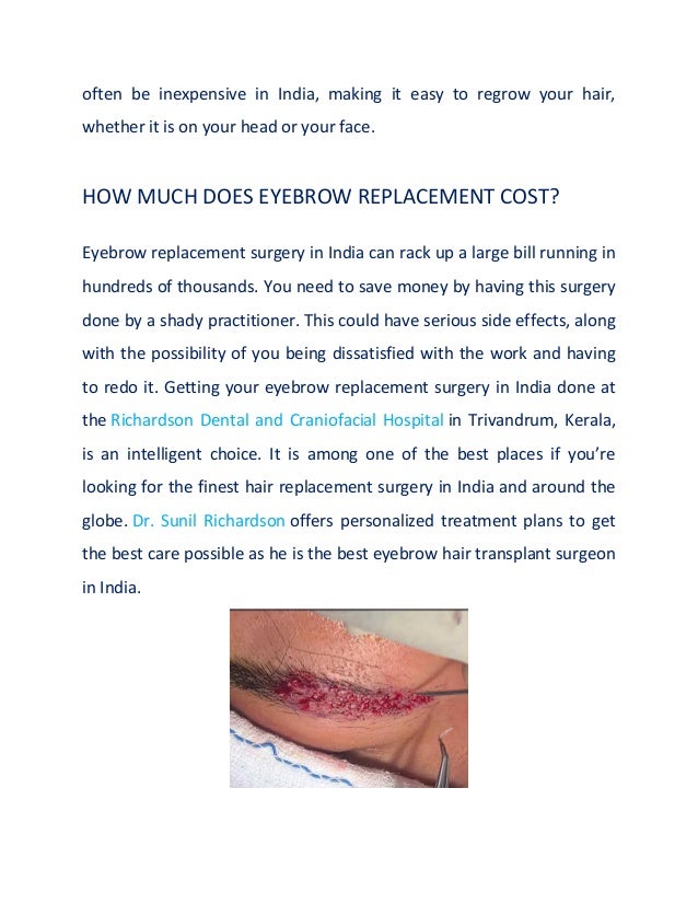 often be inexpensive in India, making it easy to regrow your hair,
whether it is on your head or your face.
HOW MUCH DOES EYEBROW REPLACEMENT COST?
Eyebrow replacement surgery in India can rack up a large bill running in
hundreds of thousands. You need to save money by having this surgery
done by a shady practitioner. This could have serious side effects, along
with the possibility of you being dissatisfied with the work and having
to redo it. Getting your eyebrow replacement surgery in India done at
the Richardson Dental and Craniofacial Hospital in Trivandrum, Kerala,
is an intelligent choice. It is among one of the best places if you’re
looking for the finest hair replacement surgery in India and around the
globe. Dr. Sunil Richardson offers personalized treatment plans to get
the best care possible as he is the best eyebrow hair transplant surgeon
in India.
 
