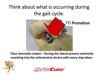 Think about what is occurring during
the gait cycle.
TTJ Pronation
Talus internally rotates – forcing the lateral process anteriorly
smashing into the arthroereisis device with every step taken.
 