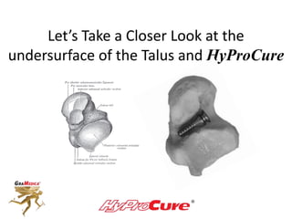 Let’s Take a Closer Look at the
undersurface of the Talus and HyProCure
 