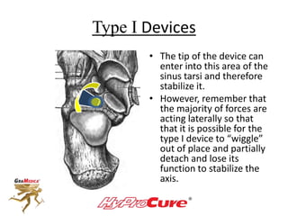 Type I Devices
• The tip of the device can
enter into this area of the
sinus tarsi and therefore
stabilize it.
• However, remember that
the majority of forces are
acting laterally so that
that it is possible for the
type I device to “wiggle”
out of place and partially
detach and lose its
function to stabilize the
axis.
 