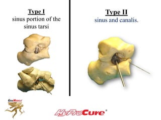Type I
sinus portion of the
sinus tarsi
Type II
sinus and canalis.
 