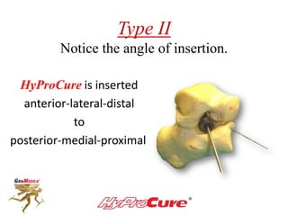 Type II
Notice the angle of insertion.
HyProCure is inserted
anterior-lateral-distal
to
posterior-medial-proximal
 