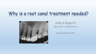 Why is a root canal treatment needed?
Julie K Kilgariff
Specialist in Endodontics
www.julie4endo.com
 