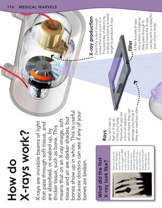 114
X-rays
are
invisible
beams
of
light
that
pass
through
soft
tissue,
and
are
absorbed,
or
soaked
up,
by
thicker
tissue,
such
as
bone.
This
means
that
on
an
X-ray
image,
soft
tissue
and
air
are
darker
shades,
but
bones
show
up
in
white.
This
is
useful
because
doctors
can
see
if
any
of
your
bones
are
broken.
How
do
X-rays
work?
Rays
You
can’t
see
or
feel
an
X-ray
as
it
hits
your
body.
However,
X-rays
are
a
form
of
radiation,
which
means
they
can
damage
your
body
if
they
are
used
too
often.
Filter
A
filter
focuses
X-rays
into
a
beam
of
light
as
they
pass
through
it.
This
means
the
X-rays
can
be
sent
to
a
specific
part
of
your
body.
X-ray
production
Electricity
is
sent
through
a
tube
that
has
no
air
in
it.
Tiny
particles
of
electricity
(in
blue)
are
fired
at
a
metal
target
to
produce
X-rays.
MEDICAL MARVELS
What
did
the
first
X-ray
look
like?
German
physicist
Wilhelm
Röntgen
took
the
first
ever
X-ray
image
in
1895.
It
was
of
his
wife’s
hand,
and
showed
her
bones
and
a
metal
ring.
Wilhelm
discovered
X-rays
by
accident
when
experimenting
with
another
type
of
ray,
cathode
rays.
 