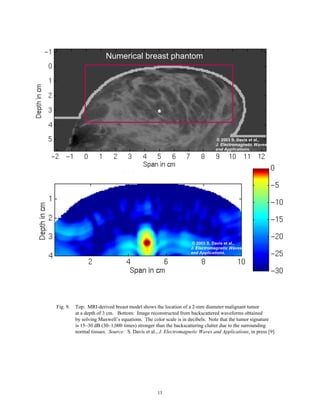 13
Fig. 9. Top: MRI-derived breast model shows the location of a 2-mm diameter malignant tumor
at a depth of 3 cm. Bottom: Image reconstructed from backscattered waveforms obtained
by solving Maxwell’s equations. The color scale is in decibels. Note that the tumor signature
is 15–30 dB (30–1,000 times) stronger than the backscattering clutter due to the surrounding
normal tissues. Source: S. Davis et al., J. Electromagnetic Waves and Applications, in press [9].
S/C 6 d
Numerical breast phantom
© 2003 S. Davis et al.,
J. Electromagnetic Waves
and Applications.
© 2003 S. Davis et al.,
J. Electromagnetic Waves
and Applications.
 