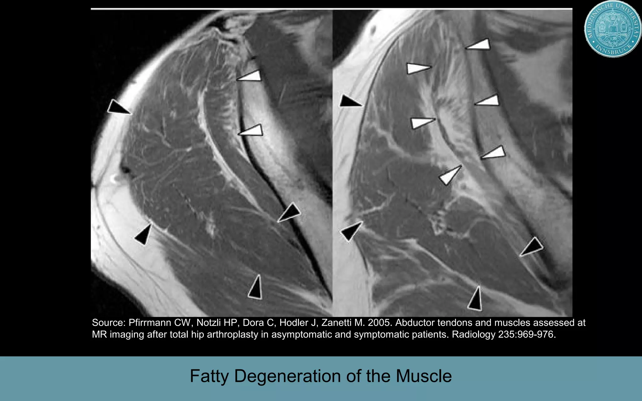 Medical University Innsbruck, AustriaMedical University Innsbruck, Austria
Fatty Degeneration of the Muscle
Source: Pfirrmann CW, Notzli HP, Dora C, Hodler J, Zanetti M. 2005. Abductor tendons and muscles assessed at
MR imaging after total hip arthroplasty in asymptomatic and symptomatic patients. Radiology 235:969-976.
 