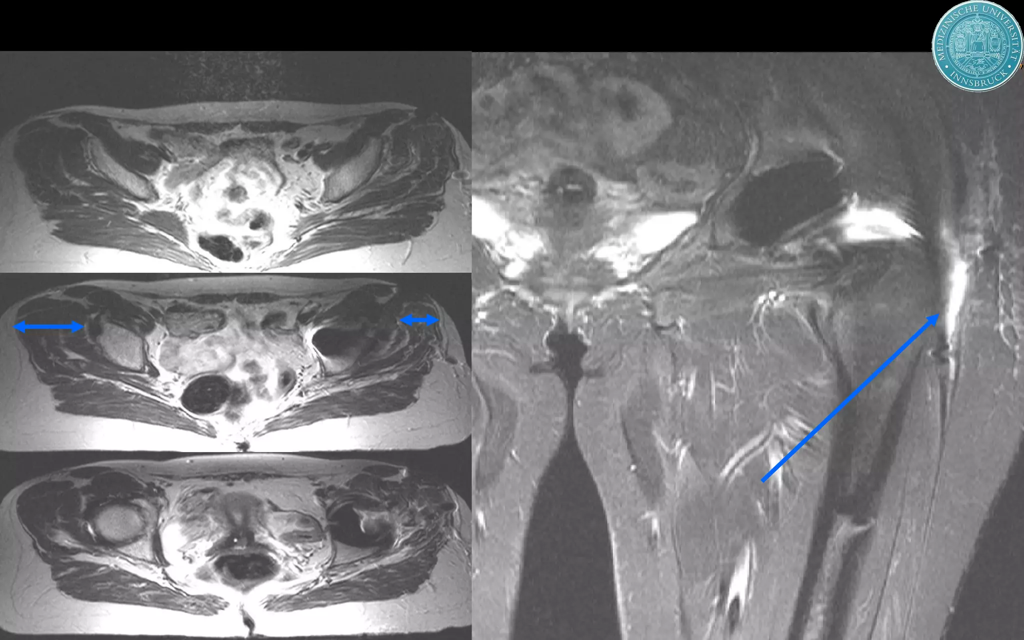 Medical University Innsbruck, AustriaMedical University Innsbruck, Austria
Havlik Angelika Glutealatrophie
 