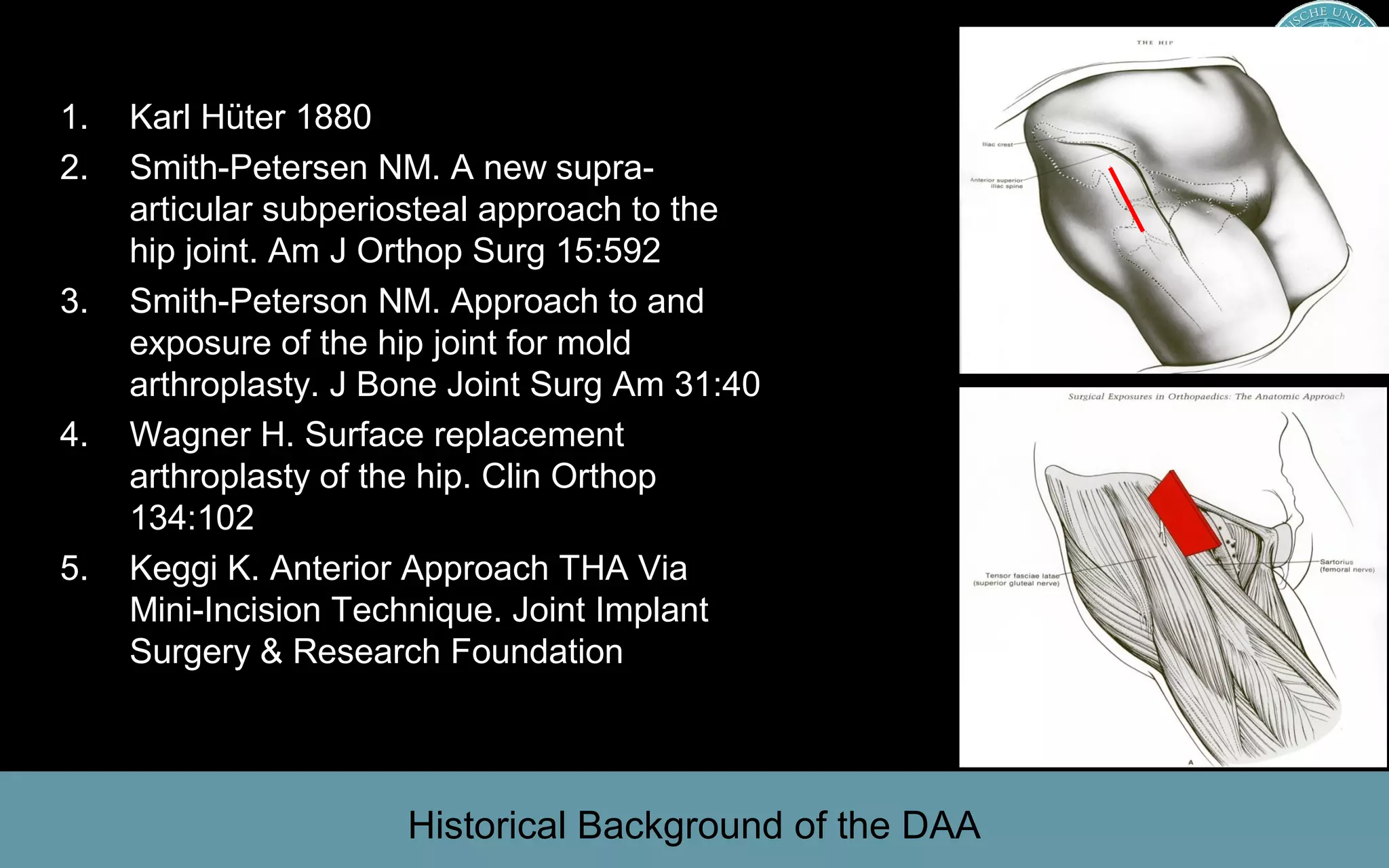 Medical University Innsbruck, AustriaMedical University Innsbruck, Austria
1. Karl Hüter 1880
2. Smith-Petersen NM. A new supra-
articular subperiosteal approach to the
hip joint. Am J Orthop Surg 15:592
3. Smith-Peterson NM. Approach to and
exposure of the hip joint for mold
arthroplasty. J Bone Joint Surg Am 31:40
4. Wagner H. Surface replacement
arthroplasty of the hip. Clin Orthop
134:102
5. Keggi K. Anterior Approach THA Via
Mini-Incision Technique. Joint Implant
Surgery & Research Foundation
Historical Background of the DAA
 