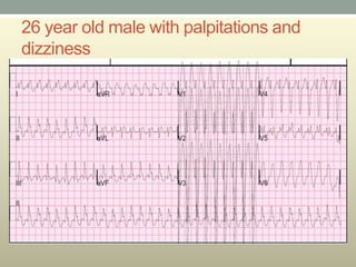 26 year old male with palpitations and
dizziness
 