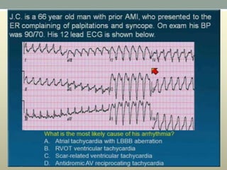 Wide complex tachycardia