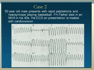 Wide complex tachycardia