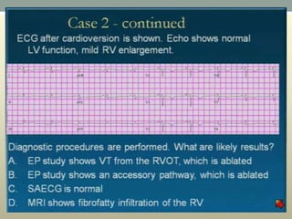 Wide complex tachycardia