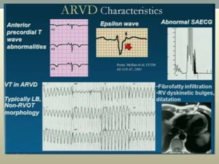 Wide complex tachycardia