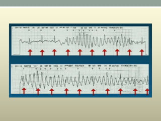 Wide complex tachycardia