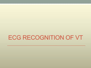 ECG RECOGNITION OF VT
 