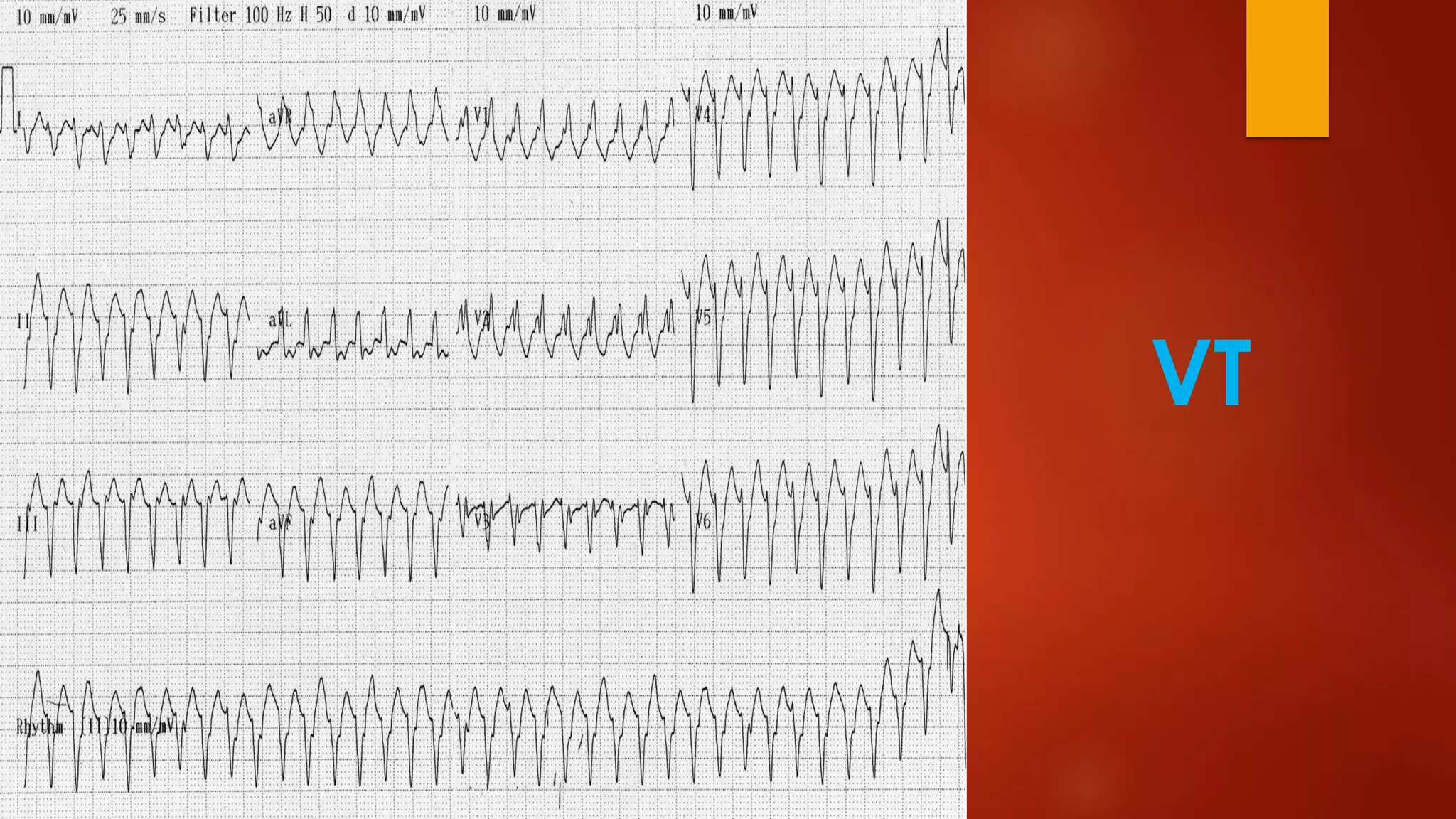 Wide Complex Tachycardia | PDF