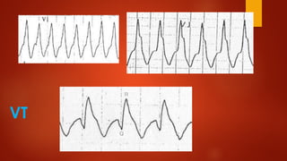 Wide Complex Vt Wide Complex Tachycardia | PDF