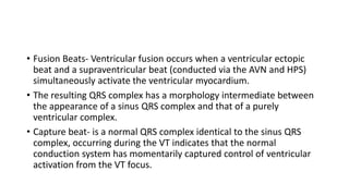• Fusion Beats- Ventricular fusion occurs when a ventricular ectopic
beat and a supraventricular beat (conducted via the AVN and HPS)
simultaneously activate the ventricular myocardium.
• The resulting QRS complex has a morphology intermediate between
the appearance of a sinus QRS complex and that of a purely
ventricular complex.
• Capture beat- is a normal QRS complex identical to the sinus QRS
complex, occurring during the VT indicates that the normal
conduction system has momentarily captured control of ventricular
activation from the VT focus.
 