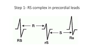 Step 1- RS complex in precordial leads
 