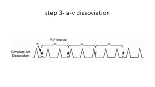 step 3- a-v dissociation
 