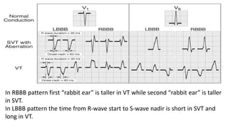 In RBBB pattern first “rabbit ear” is taller in VT while second “rabbit ear” is taller
in SVT.
In LBBB pattern the time from R-wave start to S-wave nadir is short in SVT and
long in VT.
 
