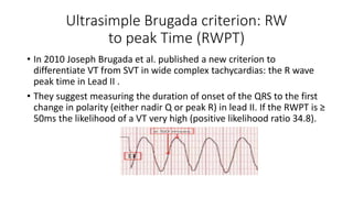 Ultrasimple Brugada criterion: RW
to peak Time (RWPT)
• In 2010 Joseph Brugada et al. published a new criterion to
differentiate VT from SVT in wide complex tachycardias: the R wave
peak time in Lead II .
• They suggest measuring the duration of onset of the QRS to the first
change in polarity (either nadir Q or peak R) in lead II. If the RWPT is ≥
50ms the likelihood of a VT very high (positive likelihood ratio 34.8).
 