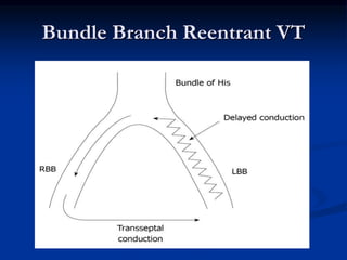 Bundle Branch Reentrant VT
 