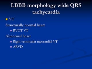 LBBB morphology wide QRS
tachycardia
 VT
Structurally normal heart
 RVOT VT
Abnormal heart
 Right ventricular myocardial VT
 ARVD
 