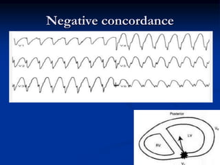 Negative concordance
 