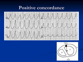 Positive concordance
 