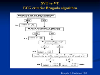 SVT vs VT
ECG criteria: Brugada algorithm
Brugada P. Ciculation 1991
 