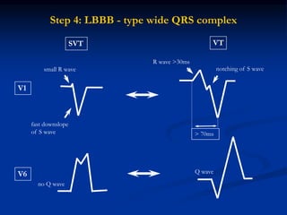 Step 4: LBBB - type wide QRS complex
SVT VT
small R wave notching of S wave
R wave >30ms
fast downslope
of S wave
no Q wave
Q wave
> 70ms
V1
V6
 