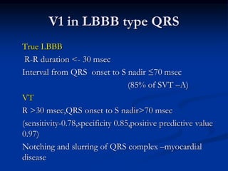 V1 in LBBB type QRS
True LBBB
R-R duration <- 30 msec
Interval from QRS onset to S nadir ≤70 msec
(85% of SVT –A)
VT
R >30 msec,QRS onset to S nadir>70 msec
(sensitivity-0.78,specificity 0.85,positive predictive value
0.97)
Notching and slurring of QRS complex –myocardial
disease
 
