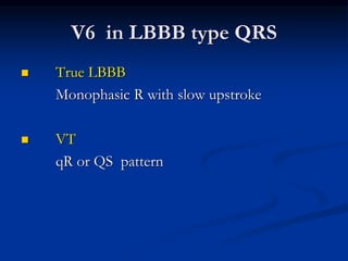V6 in LBBB type QRS
 True LBBB
Monophasic R with slow upstroke
 VT
qR or QS pattern
 