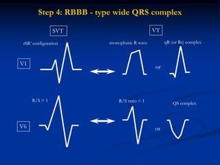 Step 4: RBBB - type wide QRS complex
SVT VT
V1
V6
or
or
R/S > 1 R/S ratio < 1 QS complex
rSR’ configuration monophasic R wave qR (or Rs) complex
 