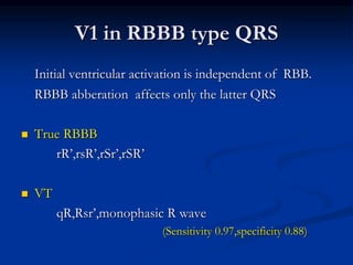 V1 in RBBB type QRS
Initial ventricular activation is independent of RBB.
RBBB abberation affects only the latter QRS
 True RBBB
rR’,rsR’,rSr’,rSR’
 VT
qR,Rsr’,monophasic R wave
(Sensitivity 0.97,specificity 0.88)
 