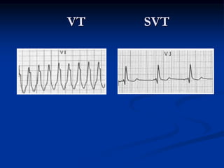 VT SVT
 