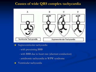  Supraventricular tachycardia
- with prexsisting BBB
- with BBB due to heart rate (aberrant conduction)
- antidromic tachycardia in WPW syndrome
 Ventricular tachycardia
Causes of wide QRS complex tachycardia
 