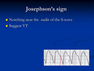 Josephson’s sign
 Notching near the nadir of the S-wave
 Suggest VT
 