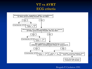 VT vs AVRT
ECG criteria
Brugada P. Ciculation 1991
 