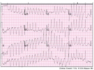 Approach to Wide complex tachycardia /cardiology | PPTX