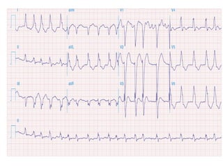 Approach to Wide complex tachycardia /cardiology | PPTX