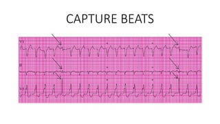 Wide complex Wide Complex Tachycardias.pptx