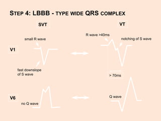 Vt R Wave Wide complex tacycardia | PPTX